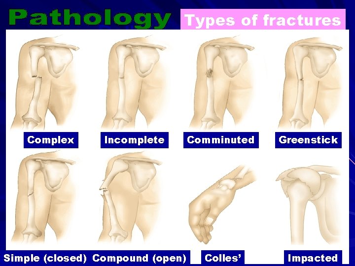 Types of fractures Pathology Part 2 Complex Incomplete Simple (closed) Compound (open) Comminuted Colles’
