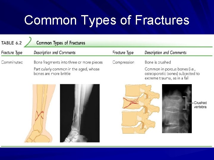 Common Types of Fractures 