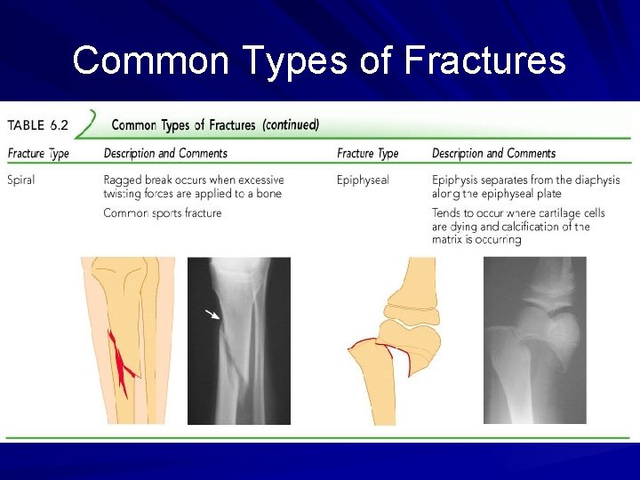 Common Types of Fractures 