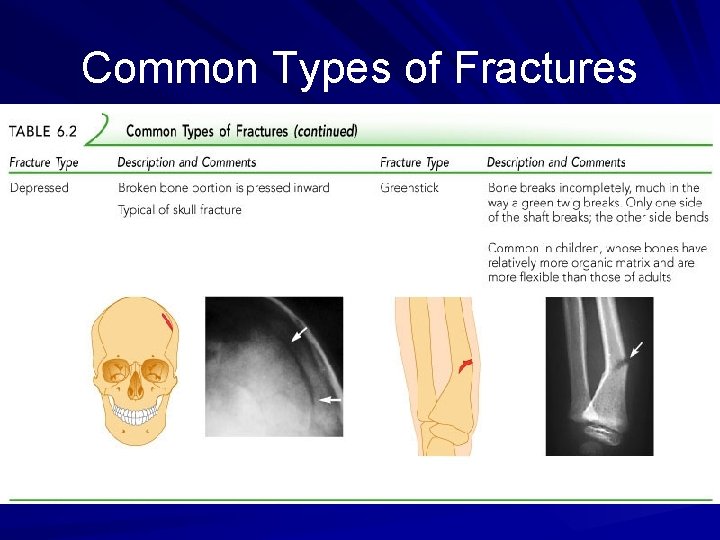 Common Types of Fractures 