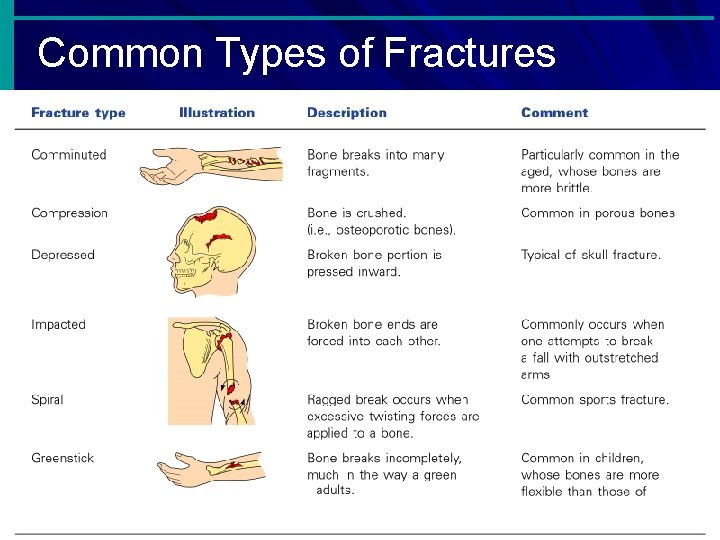 Common Types of Fractures Table 5. 2 Copyright © 2003 Pearson Education, Inc. publishing