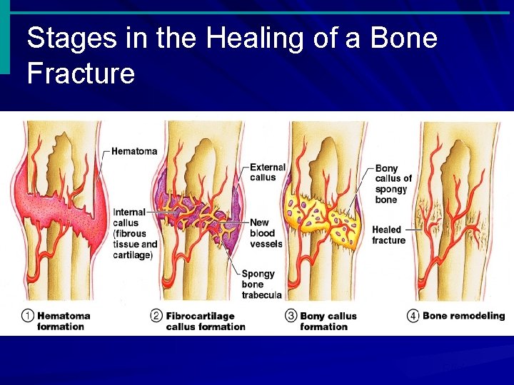Stages in the Healing of a Bone Fracture Figure 5. 5 Slide 5. 19