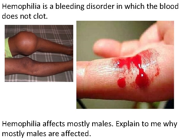 Hemophilia is a bleeding disorder in which the blood does not clot. Hemophilia affects Hemophilia is a bleeding disorder in which the blood does not clot. Hemophilia affects