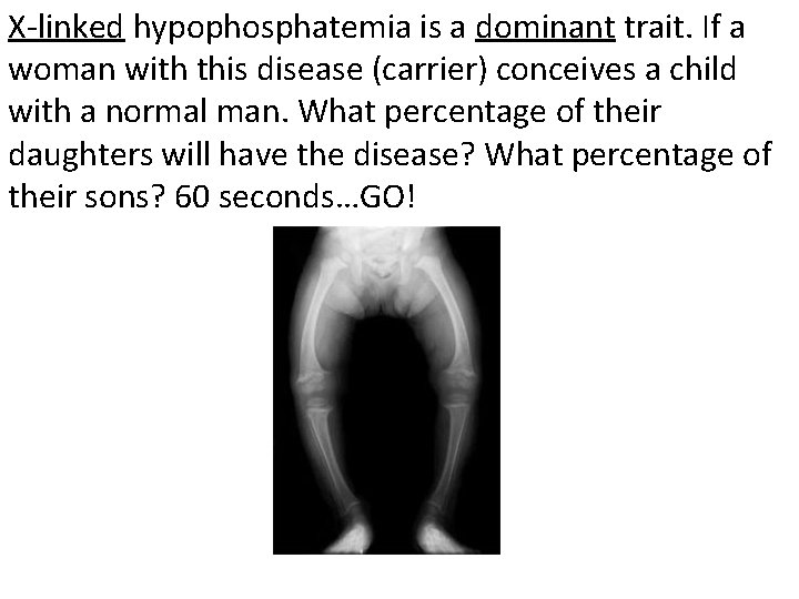 X-linked hypophosphatemia is a dominant trait. If a woman with this disease (carrier) conceives X-linked hypophosphatemia is a dominant trait. If a woman with this disease (carrier) conceives