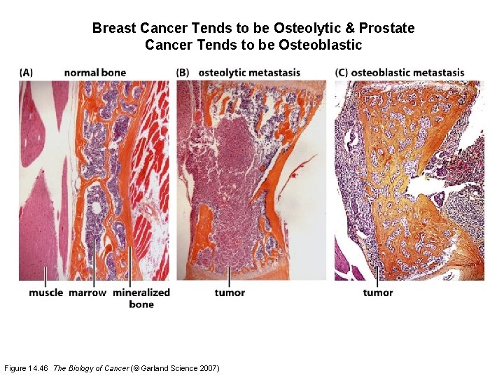 Breast Cancer Tends to be Osteolytic & Prostate Cancer Tends to be Osteoblastic Figure