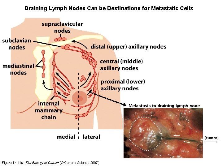 Draining Lymph Nodes Can be Destinations for Metastatic Cells Metastasis to draining lymph node