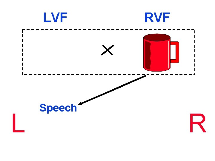 LVF L Speech RVF R 