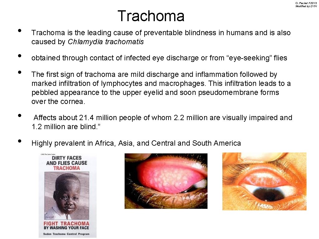  • • • Trachoma is the leading cause of preventable blindness in humans