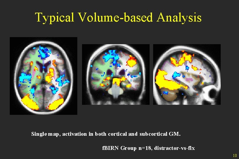 Typical Volume-based Analysis Single map, activation in both cortical and subcortical GM. f. BIRN