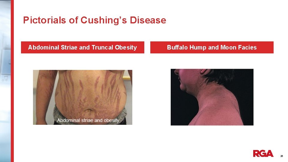 Pictorials of Cushing’s Disease Abdominal Striae and Truncal Obesity Buffalo Hump and Moon Facies