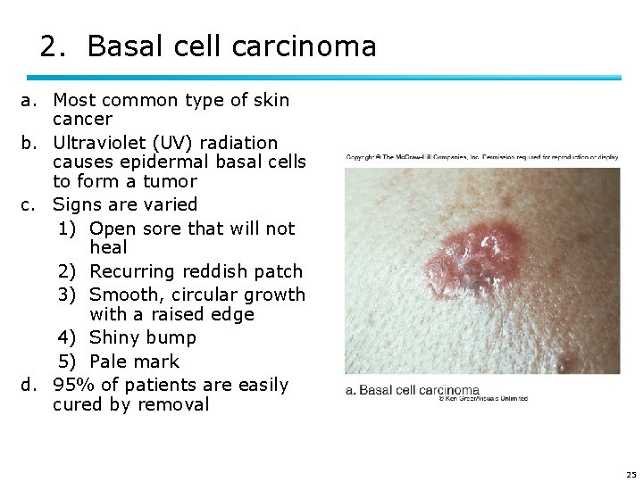 2. Basal cell carcinoma a. Most common type of skin cancer b. Ultraviolet (UV)
