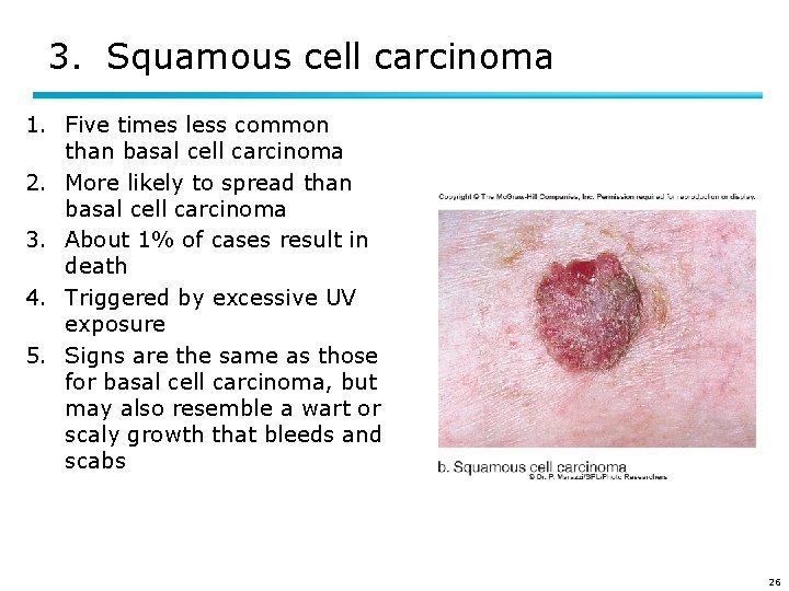 3. Squamous cell carcinoma 1. Five times less common than basal cell carcinoma 2.