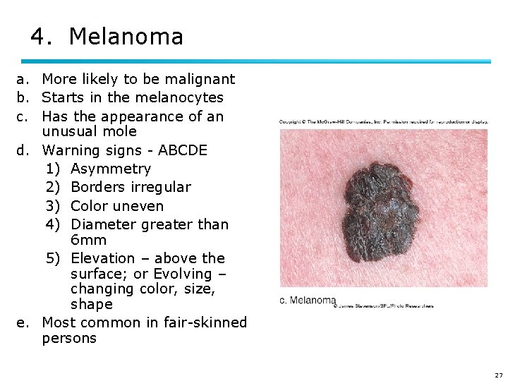 4. Melanoma a. More likely to be malignant b. Starts in the melanocytes c.