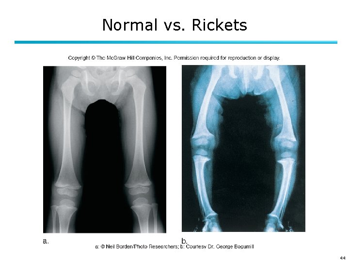 Normal vs. Rickets 44 
