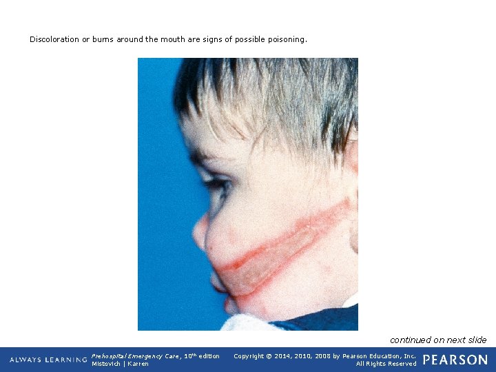 Discoloration or burns around the mouth are signs of possible poisoning. continued on next