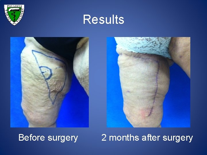 Results Before surgery 2 months after surgery 