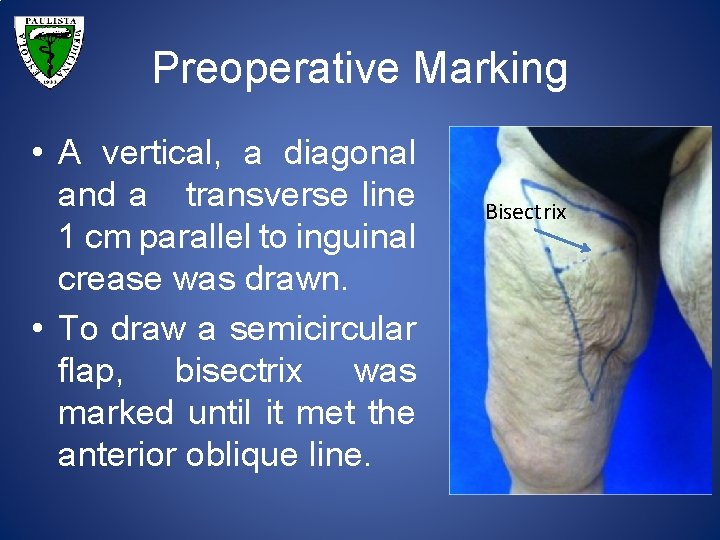 Preoperative Marking • A vertical, a diagonal and a transverse line 1 cm parallel
