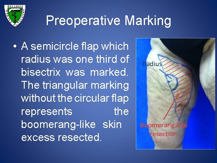 Preoperative Marking • A semicircle flap which radius was one third of bisectrix was