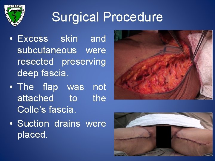 Surgical Procedure • Excess skin and subcutaneous were resected preserving deep fascia. • The