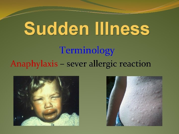 Sudden Illness Terminology Anaphylaxis – sever allergic reaction 