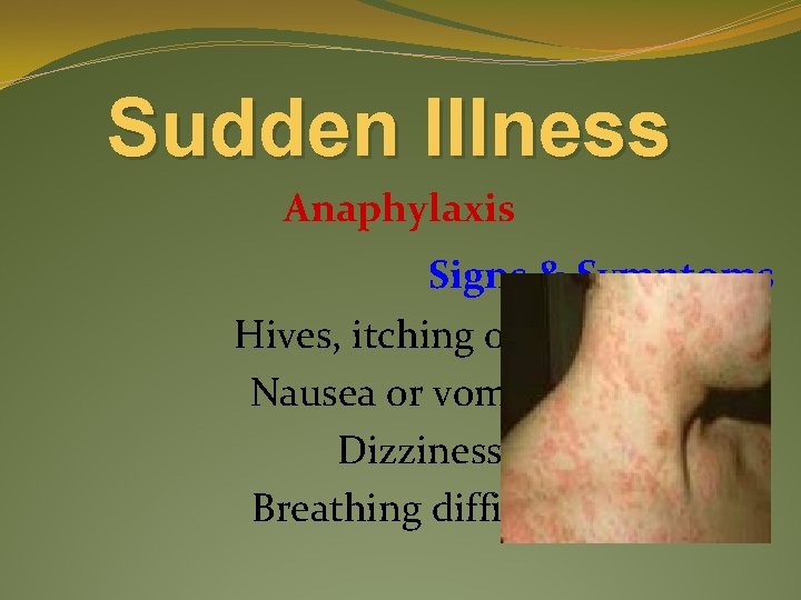Sudden Illness Anaphylaxis Signs & Symptoms Hives, itching or rash Nausea or vomiting Dizziness