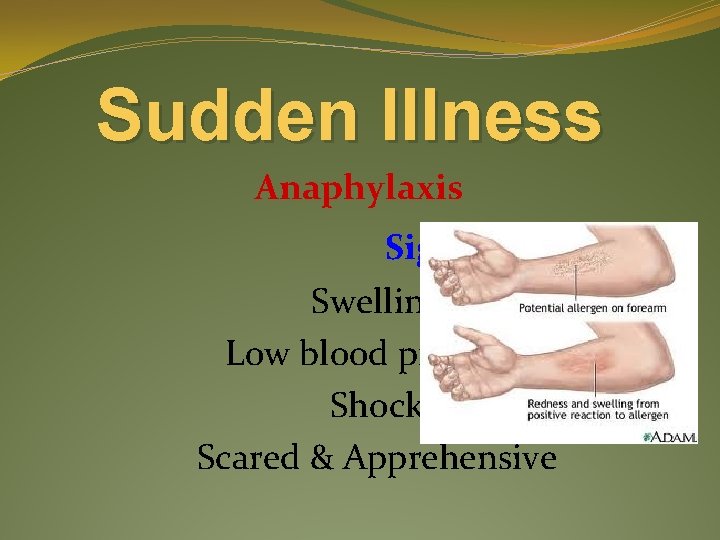 Sudden Illness Anaphylaxis Signs & Symptoms Swelling Low blood pressure Shock Scared & Apprehensive
