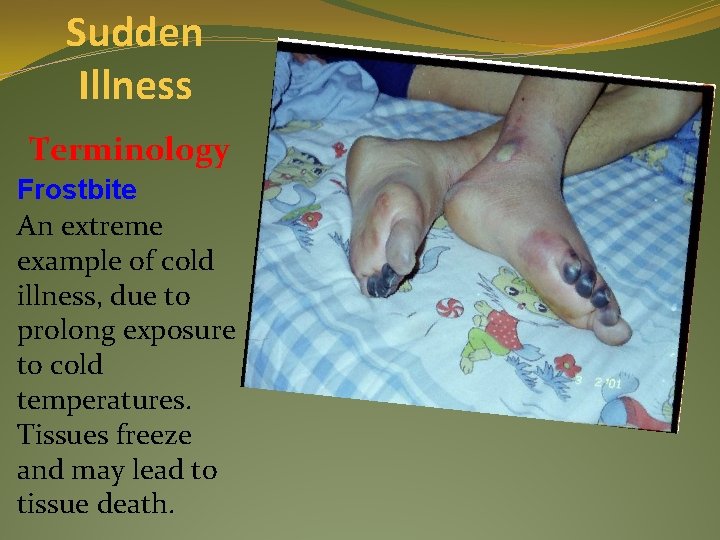 Sudden Illness Terminology Frostbite An extreme example of cold illness, due to prolong exposure