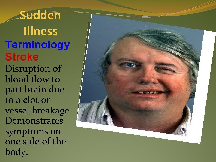Sudden Illness Terminology Stroke Disruption of blood flow to part brain due to a