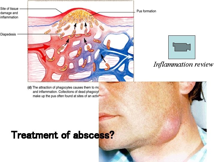 Inflammation review Treatment of abscess? 