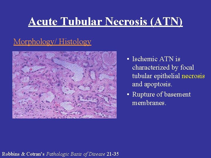 Acute Tubular Necrosis (ATN) Morphology/ Histology • Ischemic ATN is characterized by focal tubular