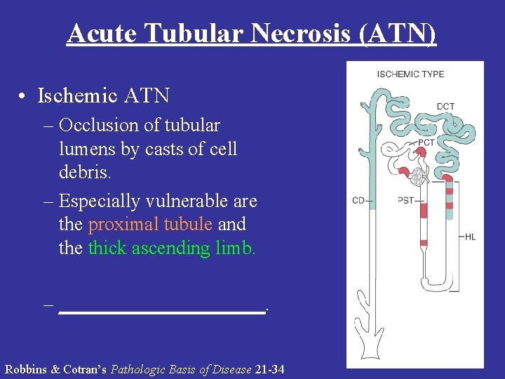 Acute Tubular Necrosis (ATN) • Ischemic ATN – Occlusion of tubular lumens by casts Acute Tubular Necrosis (ATN) • Ischemic ATN – Occlusion of tubular lumens by casts