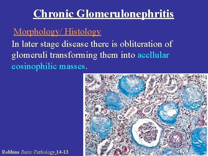 Chronic Glomerulonephritis Morphology/ Histology In later stage disease there is obliteration of glomeruli transforming