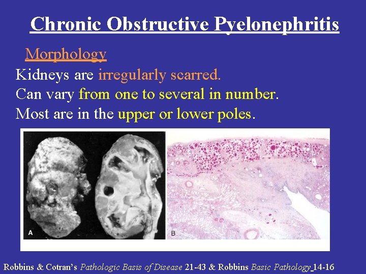 Chronic Obstructive Pyelonephritis Morphology Kidneys are irregularly scarred. Can vary from one to several Chronic Obstructive Pyelonephritis Morphology Kidneys are irregularly scarred. Can vary from one to several