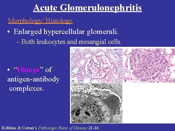 Acute Glomerulonephritis Morphology/ Histology • Enlarged hypercellular glomeruli. – Both leukocytes and mesangial cells.