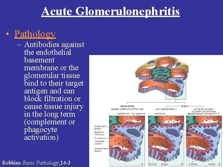 Acute Glomerulonephritis • Pathology – Antibodies against the endothelial basement membrane or the glomerular Acute Glomerulonephritis • Pathology – Antibodies against the endothelial basement membrane or the glomerular