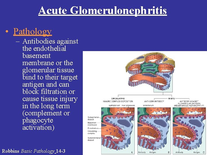 Acute Glomerulonephritis • Pathology – Antibodies against the endothelial basement membrane or the glomerular