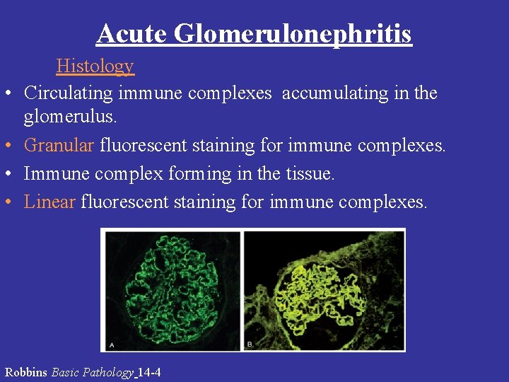 Acute Glomerulonephritis • • Histology Circulating immune complexes accumulating in the glomerulus. Granular fluorescent