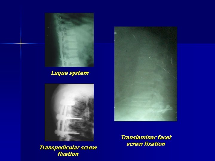 Luque system Transpedicular screw fixation Translaminar facet screw fixation 