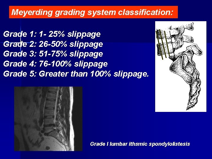 Meyerding grading system classification: Grade 1: 1 - 25% slippage Grade 2: 26 -50%