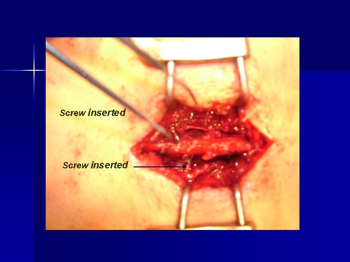 Screw inserted 