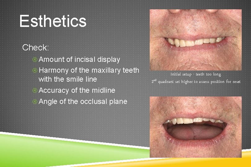 Esthetics Check: Amount of incisal display Harmony of the maxillary teeth with the smile