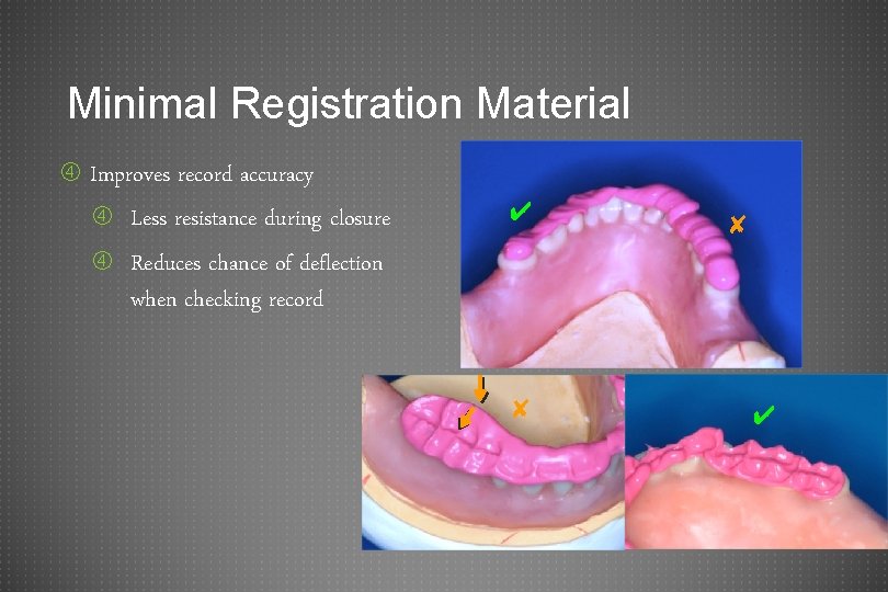 Minimal Registration Material Improves record accuracy Less resistance during closure ✔ ✘ Reduces chance