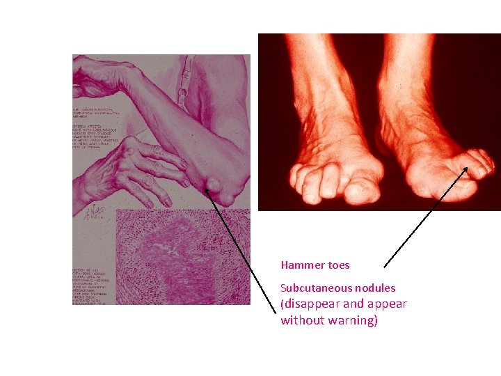Hammer toes Subcutaneous nodules (disappear and appear without warning) 