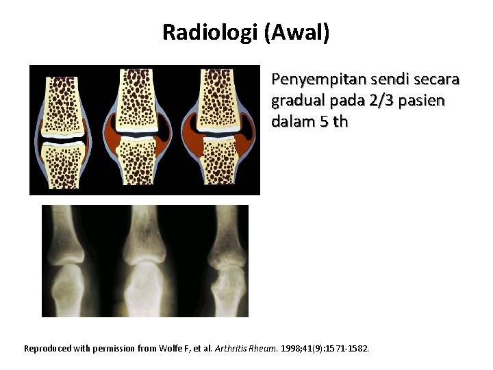 Radiologi (Awal) Penyempitan sendi secara gradual pada 2/3 pasien dalam 5 th Reproduced with