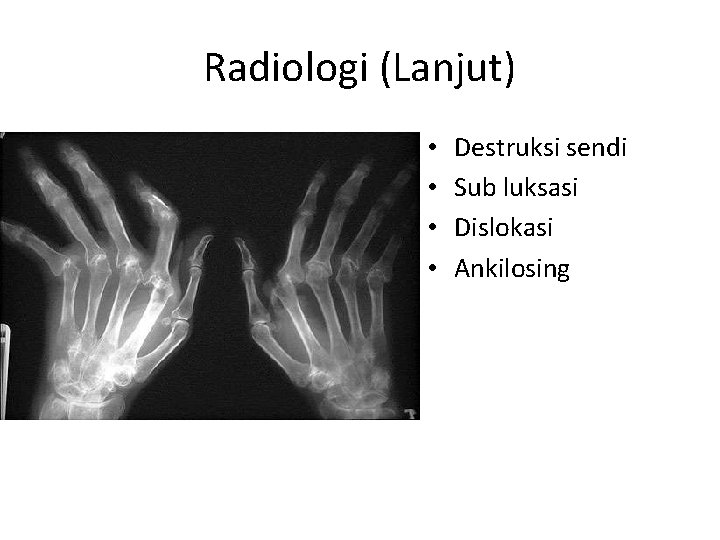 Radiologi (Lanjut) • • Destruksi sendi Sub luksasi Dislokasi Ankilosing 