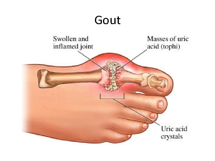 Gout 