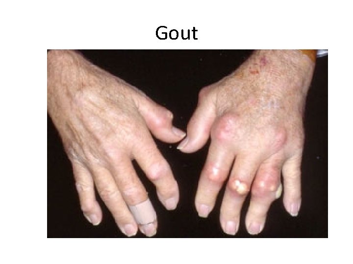 Gout 