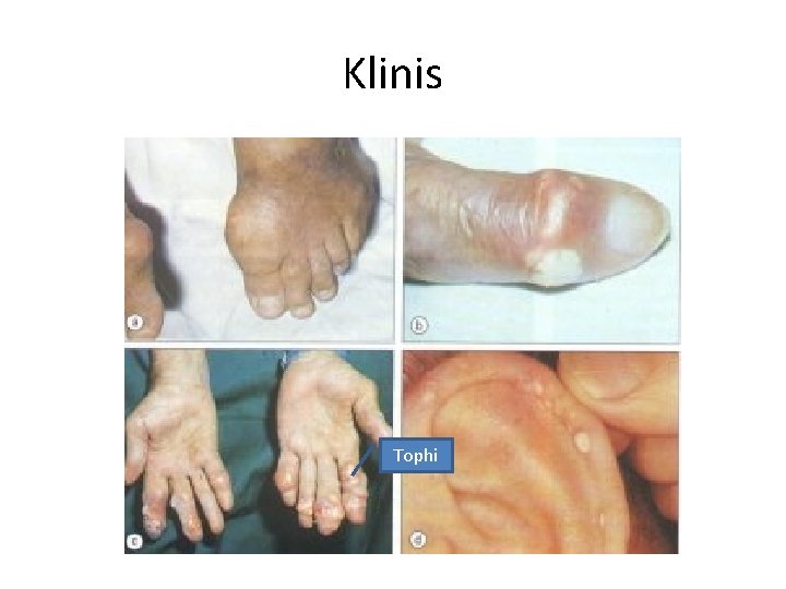 Klinis Tophi 