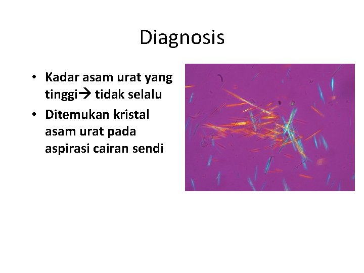 Diagnosis • Kadar asam urat yang tinggi tidak selalu • Ditemukan kristal asam urat