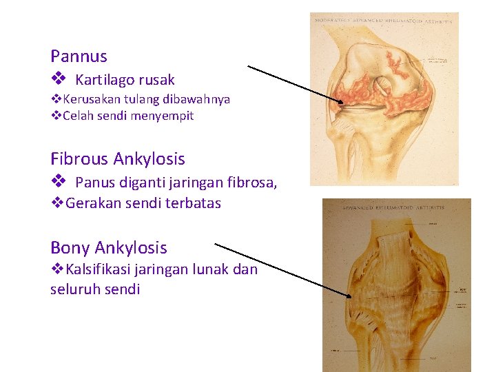Pannus v Kartilago rusak v. Kerusakan tulang dibawahnya v. Celah sendi menyempit Fibrous Ankylosis